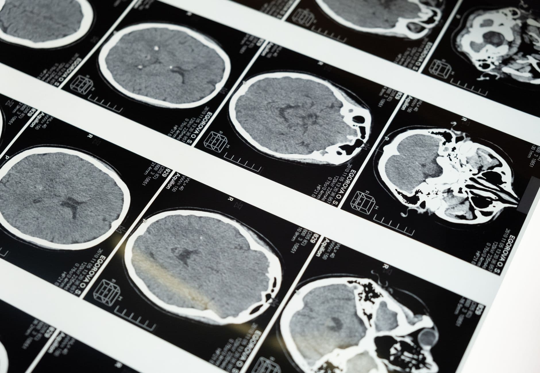 Detailed brain MRI scans displayed on a lightbox, showcasing medical imaging techniques.